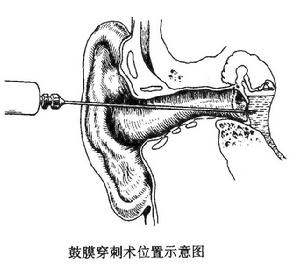 急性化膿性中耳炎