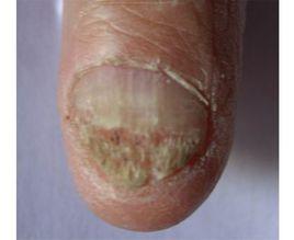 化膿性灰指甲
