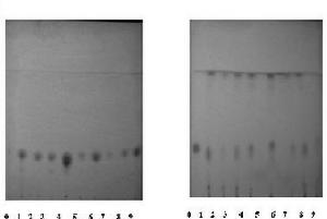 正己烷中毒-----診斷要點