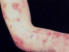 復發性線性棘層松解性皮膚病 復發性線性棘層松解性皮膚病