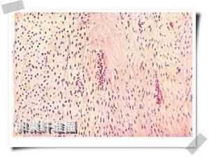 卵巢纖維瘤 卵巢纖維瘤