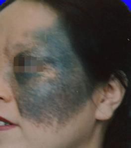 眶周色素沉著 眶周色素沉著