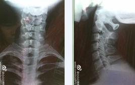 頸椎失穩症 頸椎失穩症