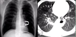 球上頜囊腫 球上頜囊腫