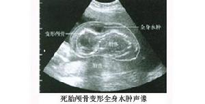 （圖）死胎