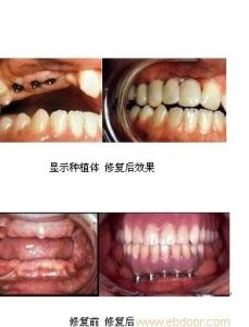 口腔修復 口腔修復