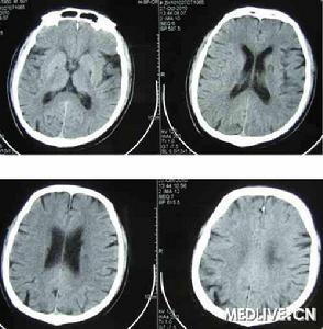 言語性失語 言語性失語
