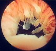 慢性細菌性膀胱炎 慢性細菌性膀胱炎