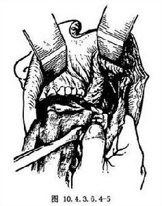 下頜骨矩形切除術