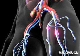 靜脈栓塞 靜脈栓塞