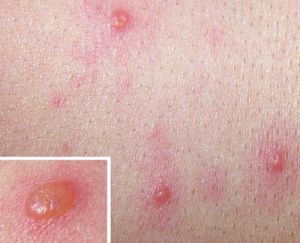 水痘和帶狀皰疹