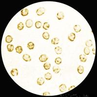 尿紅細胞位相檢查 尿紅細胞位相檢查