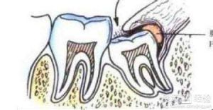急性冠周炎 急性冠周炎