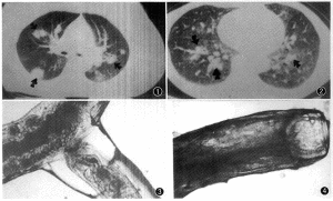 禽比翼線蟲病 禽比翼線蟲病