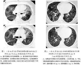 間質性肺病