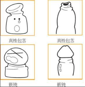 真性包莖 真性包莖