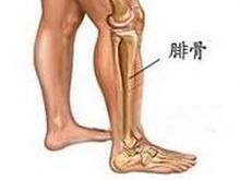 腓神經麻痹 腓神經麻痹