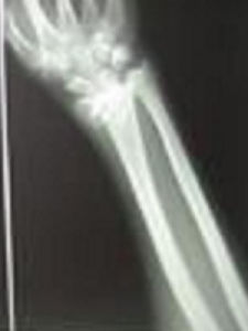 克雷氏骨折 克雷氏骨折