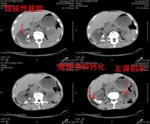 腎結核對側腎積水