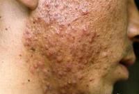 尋常性痤瘡 尋常性痤瘡