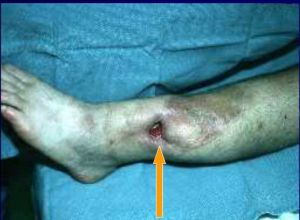 慢性化膿性骨髓炎 慢性化膿性骨髓炎