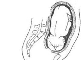 枕橫位入盆 枕橫位入盆