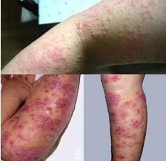 頑固性濕疹 頑固性濕疹