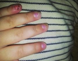 幼稚園兒童指甲斷裂事件 幼稚園兒童指甲斷裂事件