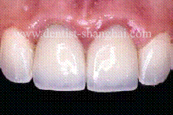 上頜竇惡性腫瘤