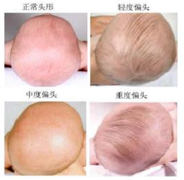 寶寶睡偏頭 寶寶睡偏頭