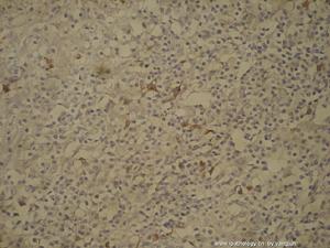 愛滋病性頸淋巴結腫大