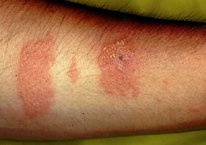 胳膊上的依賴性皮炎