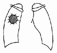 原發性肺動脈高壓