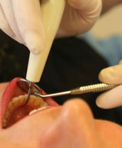 牙結石預防