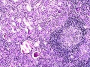 喬本氏甲狀腺炎 喬本氏甲狀腺炎