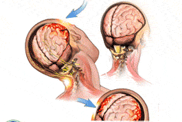 隱源性癲癇 隱源性癲癇