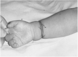 先天性環狀束帶 先天性環狀束帶