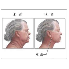 除皺手術 除皺手術