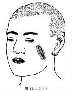 面部黑痣切除術 面部黑痣切除術