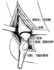 踝關節軟骨損傷 踝關節軟骨損傷