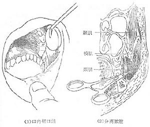 手掌筋膜間隙感染 手掌筋膜間隙感染