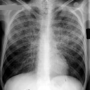 肺囊蟲性肺炎 肺囊蟲性肺炎