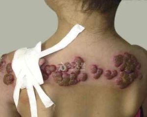 化膿性肉芽腫 化膿性肉芽腫