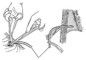 胸腔閉式引流術