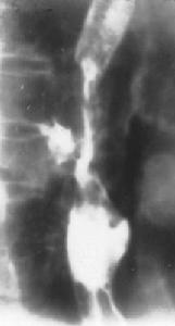 （圖）肛周腫瘤