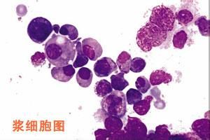 單克隆丙種球蛋白病伴周圍神經病 單克隆丙種球蛋白病伴周圍神經病