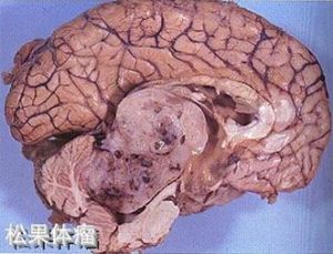 松果體瘤 松果體瘤