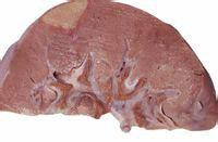 貧血性梗死 貧血性梗死