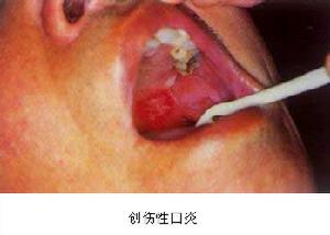 急性紅斑型念珠菌性口炎 急性紅斑型念珠菌性口炎