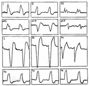 完全性左束支傳導阻滯 心電圖